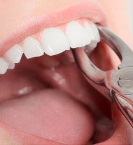 Extraciones dentales simples