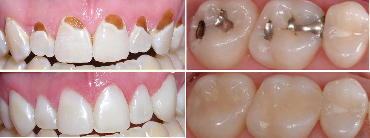 obsturaciones-tratamientos-curativos-de-odontologia