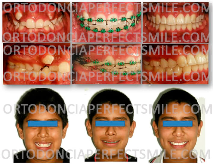 ortodoncia-adolescentes-el-salvador-tratamiento-temprano-en-adolescente-con-caninos-montados