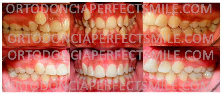 ortodoncia-adultos-el-salvador-ausencia-de-espacio-y-desalineaciones-dentales