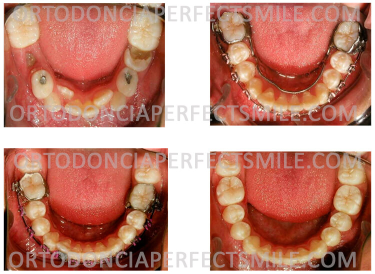 ortodoncia-ninos-apinamiento-severo-inferior-mas-perdida-prematura-de-una-molar-de-nino