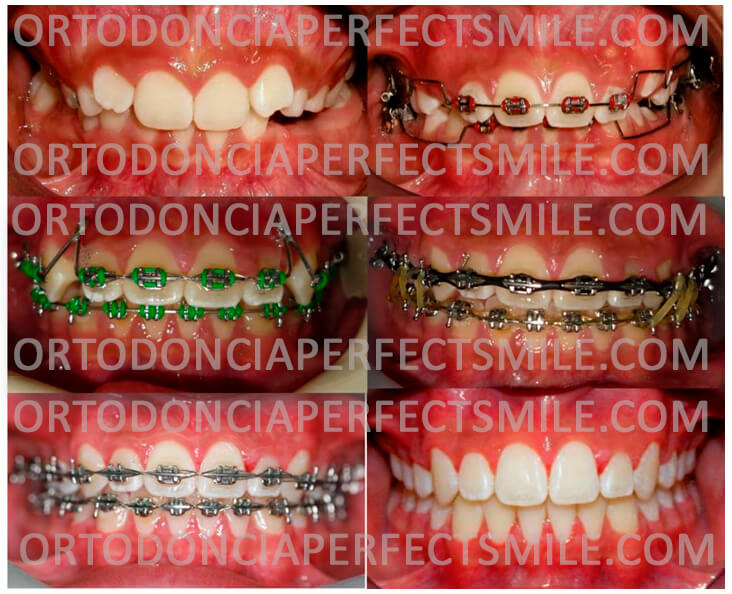 ortodoncia-ninos-paciente-con-denticion-mixta-dientes-de-nino-y-de-adulto-tratado-a-temprana-edad