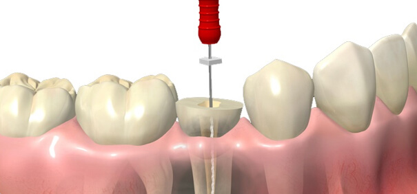 tratamiento-de-endodoncia-el-salvador